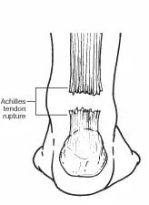 Achilles Tendon Rupture02