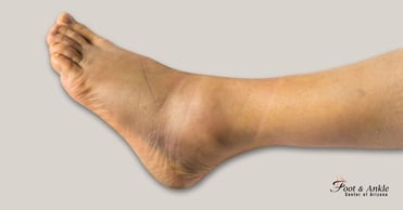 Ankle Sprains