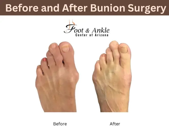 Before and After Bunion Surgery