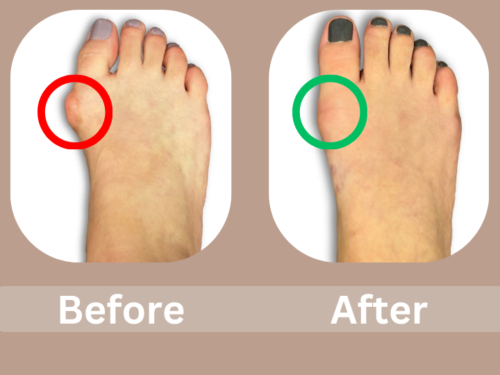 Bunion Surgery Before and After