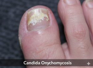 Candida Onychomycosis