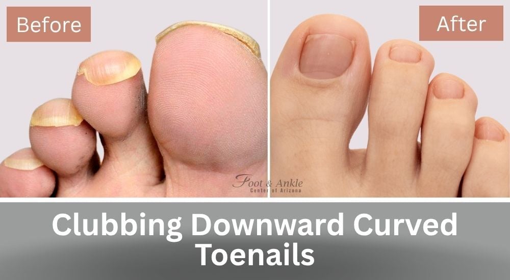Clubbing Downward Curved Toenails Before and After