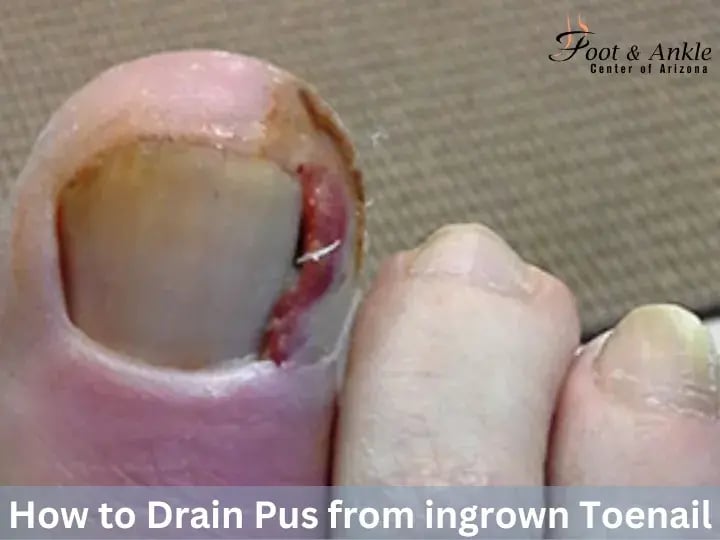 How to drain pus from ingrown toenail