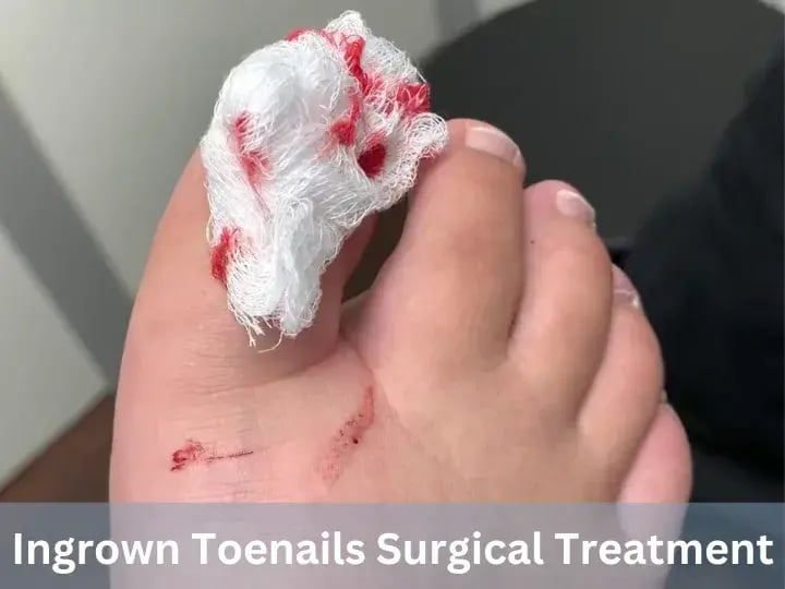 Ingrown Toenails Surgical Treatment