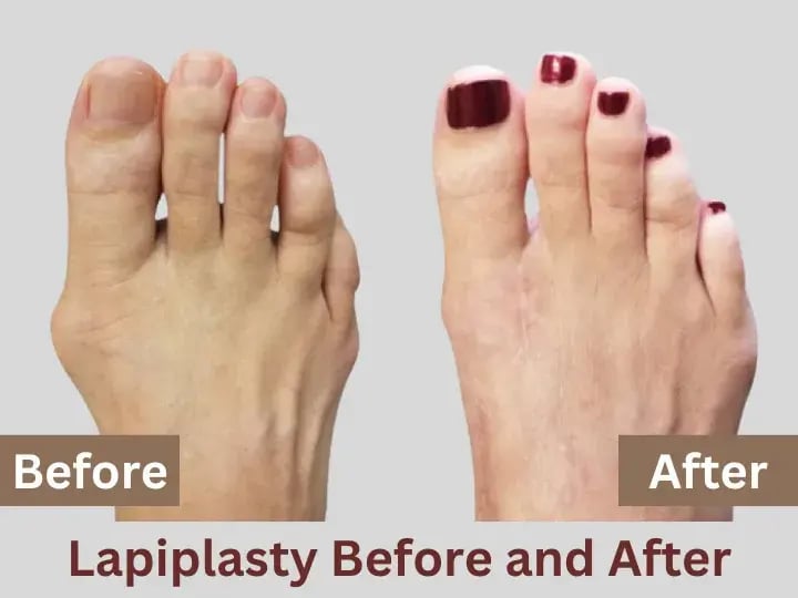Lapiplasty Before and After