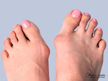 Minimally Invasive Bunion Surgery