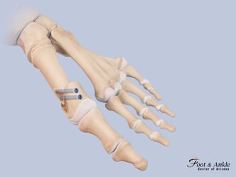 Osteotomy