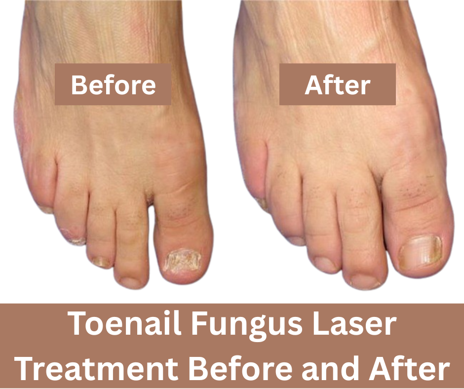 toenail fungus treatment before and after