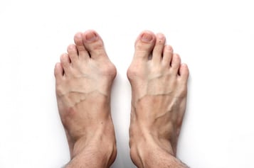 Bunions and Bunionettes