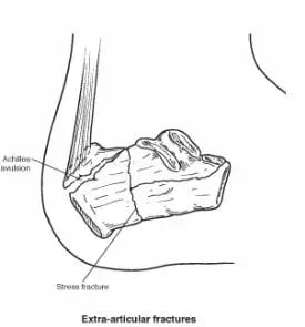 Fractures of the Calcaneus (Heel Bone Fractures)