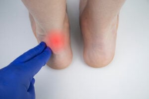Achilles Tendon Ruptures Achilles Tendon Ruptures