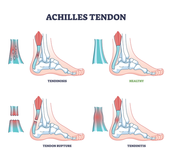 Achilles Tendon Ruptures Achilles Tendon Ruptures