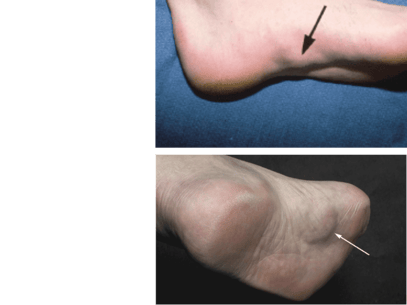 what does plantar fibroma look like