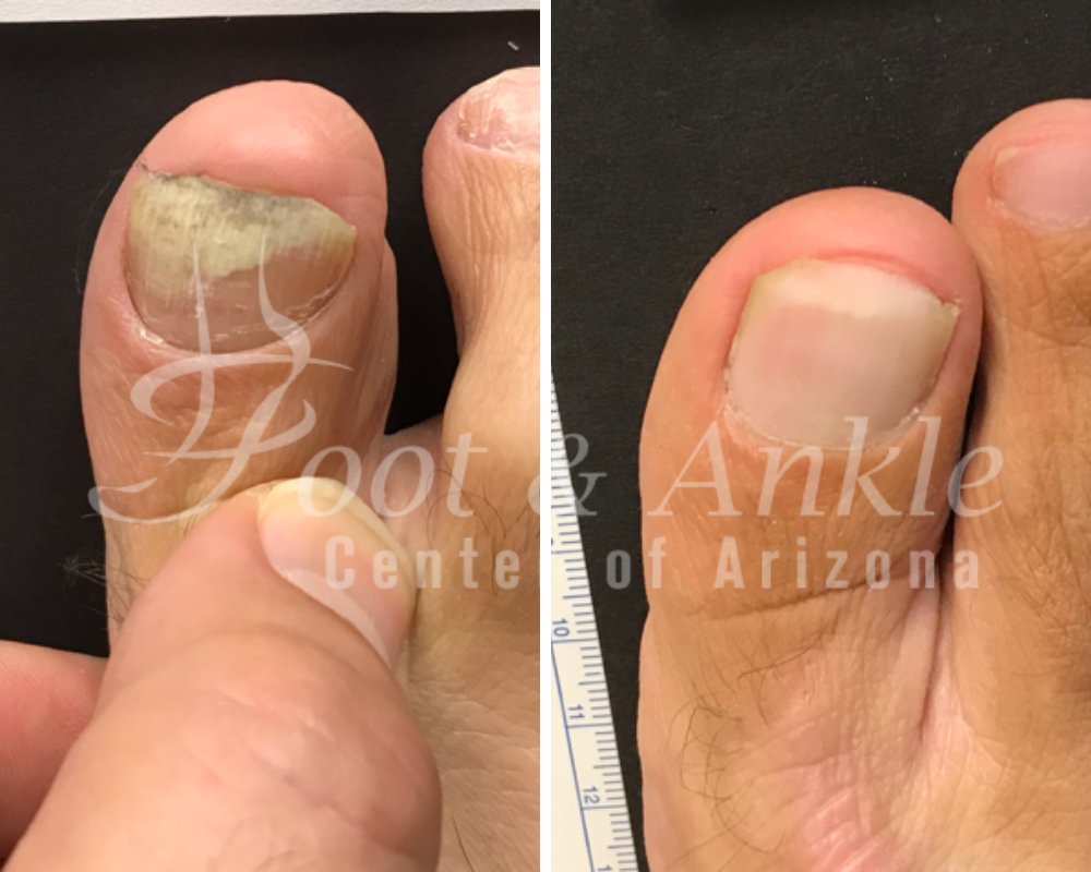 toe fungus laser treatment